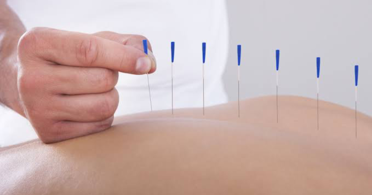 Acupuncture reduces radiationinduced dry mouth for cancer patients study